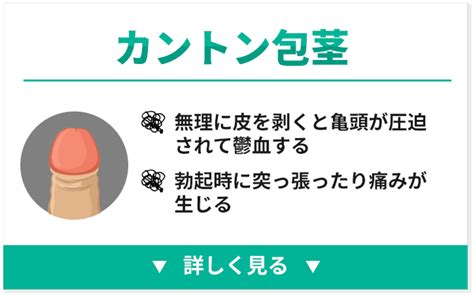 かんとんほう|カントン包茎とは？手術方法・費用を医師が解説！